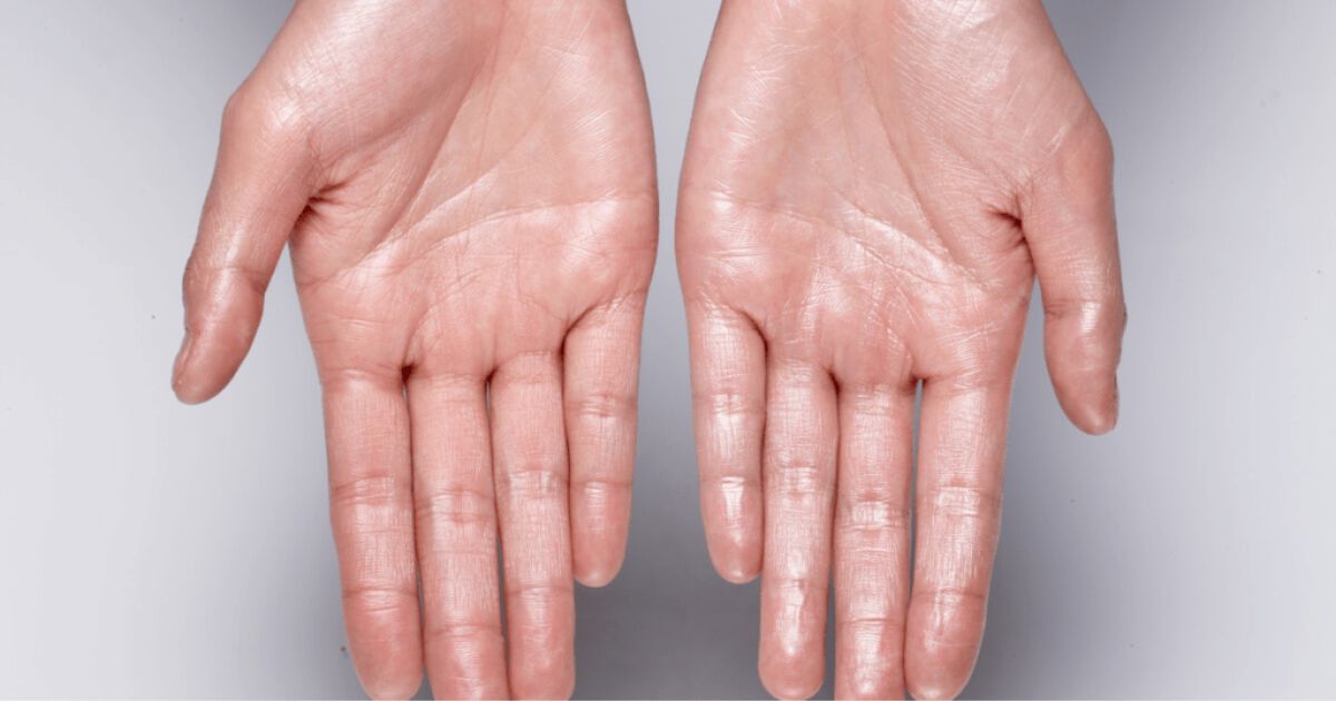 Understanding Sweaty Hands