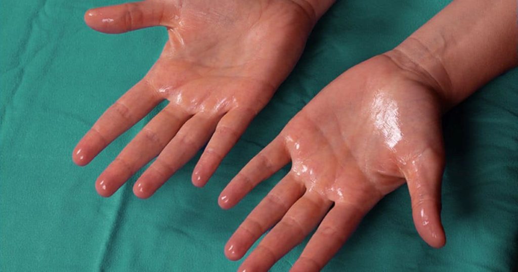 What are Sweaty Hands?